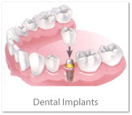 another picture of implants